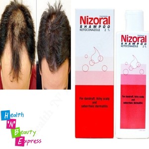 Hair Loss Shampoo: Nizoral Hair Loss Shampoo 2 Ketoconazole