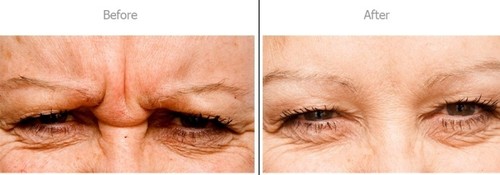 ARGIRELINE-LEUPHAXYL-PEPTIDE-INGREDIENT-BLEND-crows-feet-glabellar-line