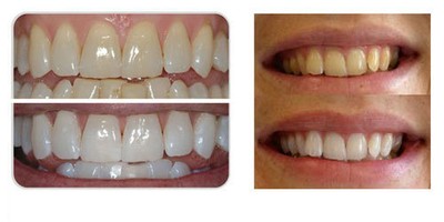 Teeth Whitening with Opalescence Go Teeth Whitening with Opalescence Go
