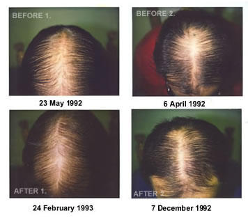 Corticosteroids injections for hair loss