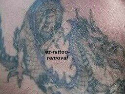 Chemical Tatto on 2bott 100 Peel Tattoo Removal Remover Chemical Facial   Ebay