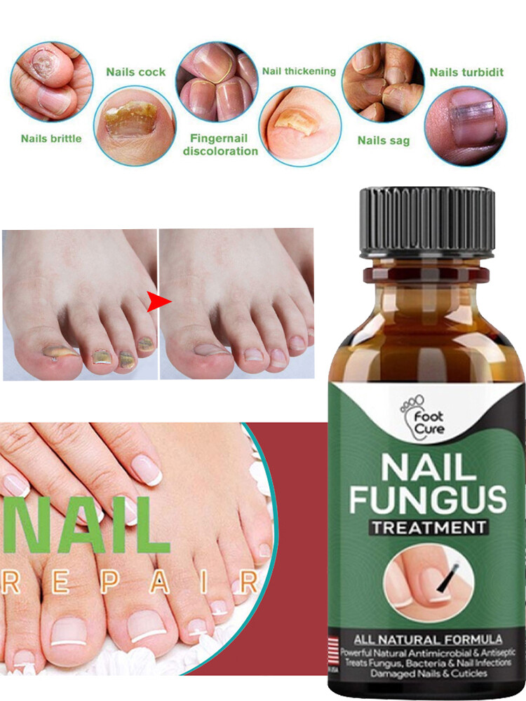 Anti Nagelpilz Finger Pilz Entfernung Fußpilz Pflege Behandlung Reparatur 50ml