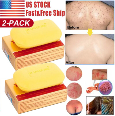 2Pack Sulfur Soap Mite Remover Soap Anti Fungal Scabies Acne Treatment Bath Soap