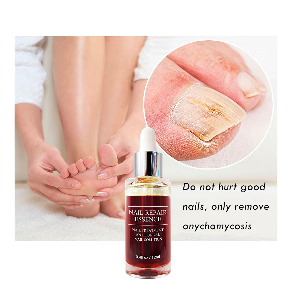 fungal infection thickened toenail onychomycosis funga infect 12ml professionail