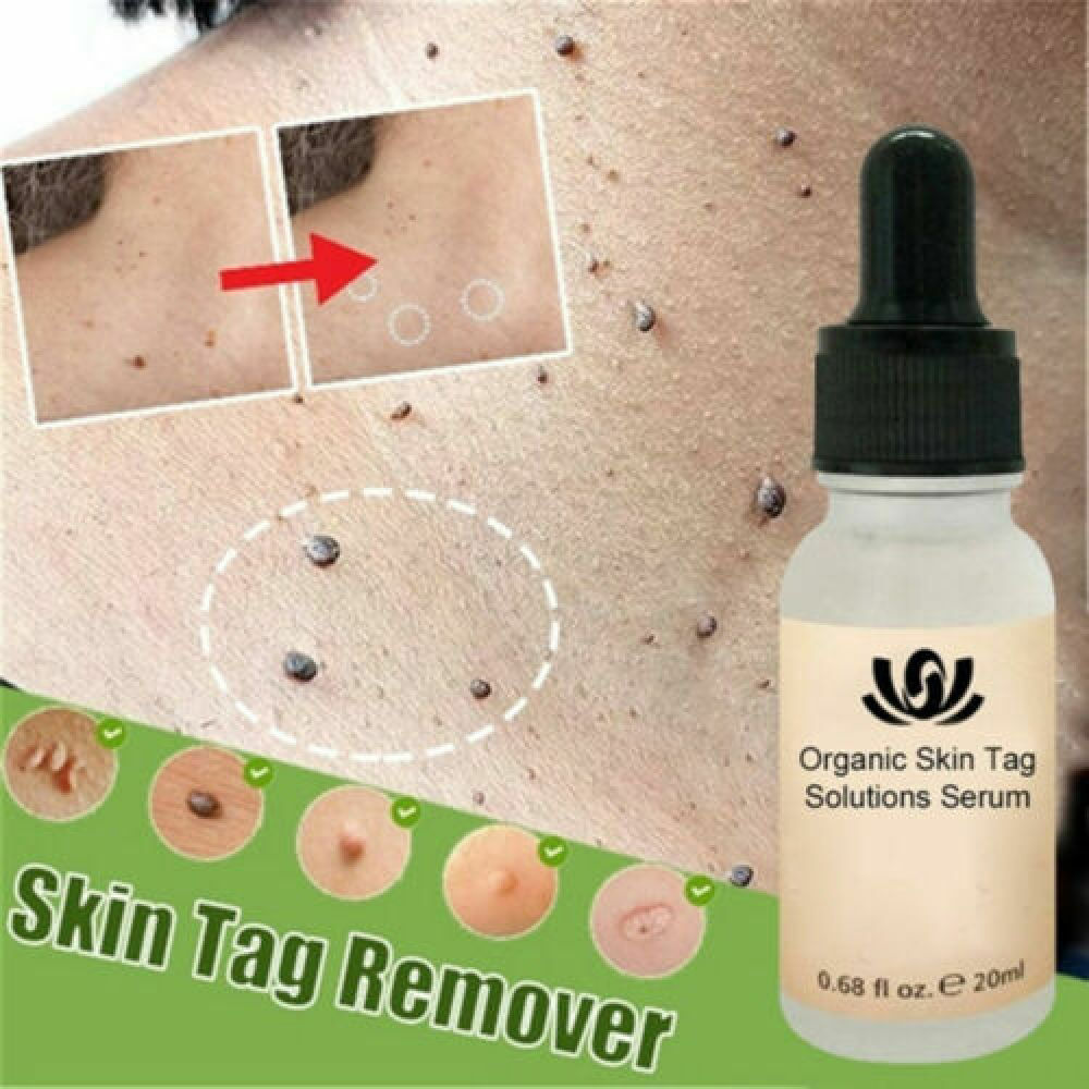 12 Hours Skin Tag Remover Serum Wart Mole Foot Corns Completely Eliminate Unisex