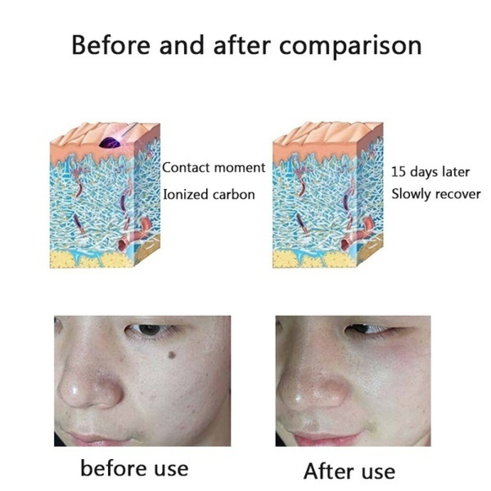 Warts Skin Tag Remover Cream / Laser Plasma Pen Moles Tattoo Removal Machine