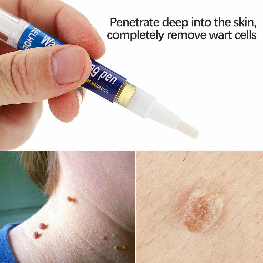 12 Hours Skin Tag Mole Wart Remover Pen Foot Corn Treatment Cream Eliminate US