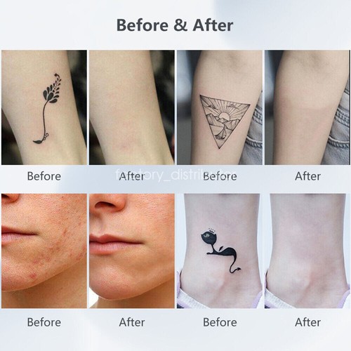 Picosecond Skin Laser Beauty Machine Tattoo/Spot Removal Pigment Pen For Freckle