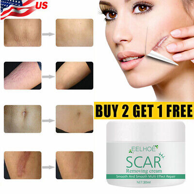 Repair Scar cream Removal Acne Scars gel Stretch Marks Surgical scar Burn Body!