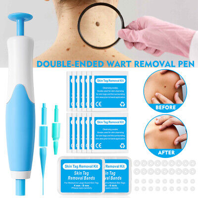 Painless 2in1 Auto Skin Tag (40x Rubber Bands +10x Alcohol Pad)Mole Wart Removal