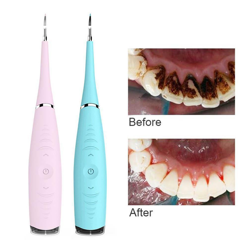 Electric Sonic Pic Tooth Stain Eraser Plaque Remover Dental ...