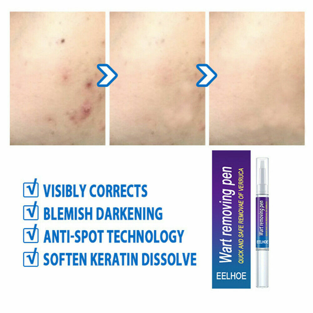 12 Hours Skin Tag Mole Wart Remover Pen Foot Corn Treatment Cream Eliminate US