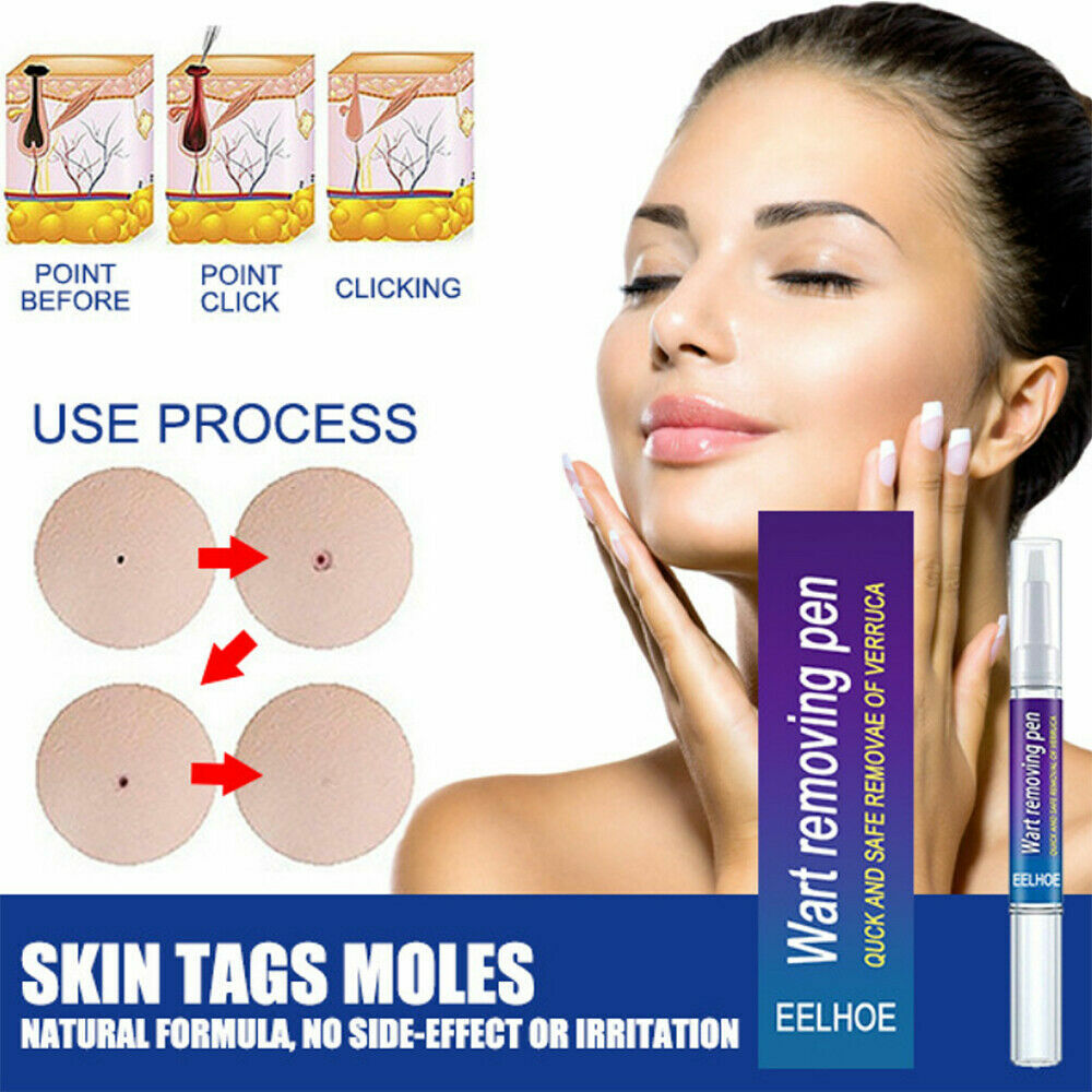 12 Hours Skin Tag Mole Wart Remover Pen Foot Corn Treatment Cream Eliminate US