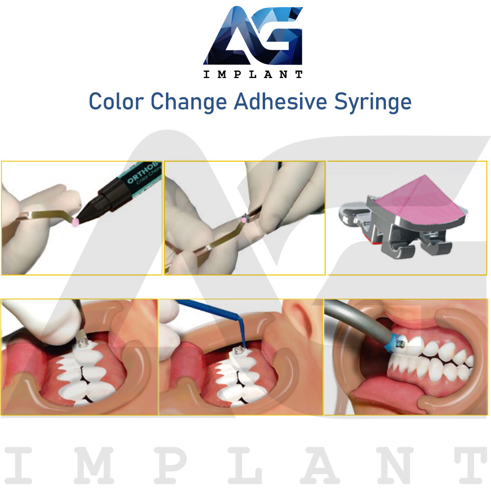 Color Change Adhesive Bonding Brackets Light Cure Glue Braces