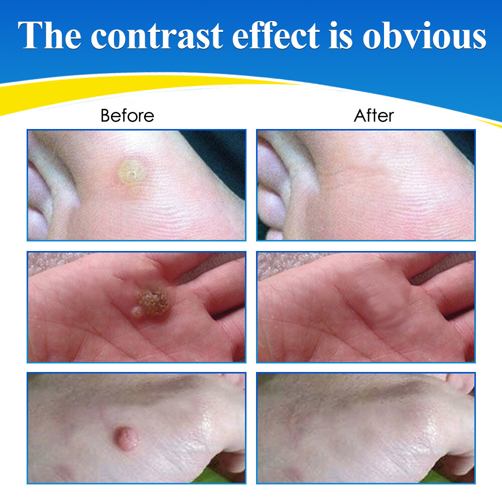 Wart Remover Liquid Skin Tag Mole Remover Eliminate Feet Corn Wart Remove Liquid