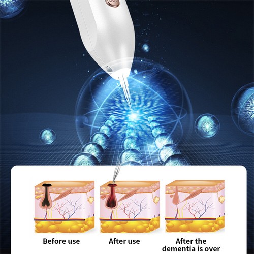 Laser Plasma Pen Mole Removal Dark Spot Skin Tag Tattoo Mole Wart Remover Pen