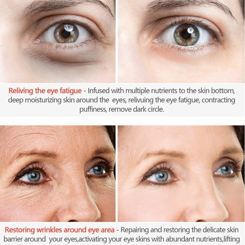 eye bag and dark circle removal