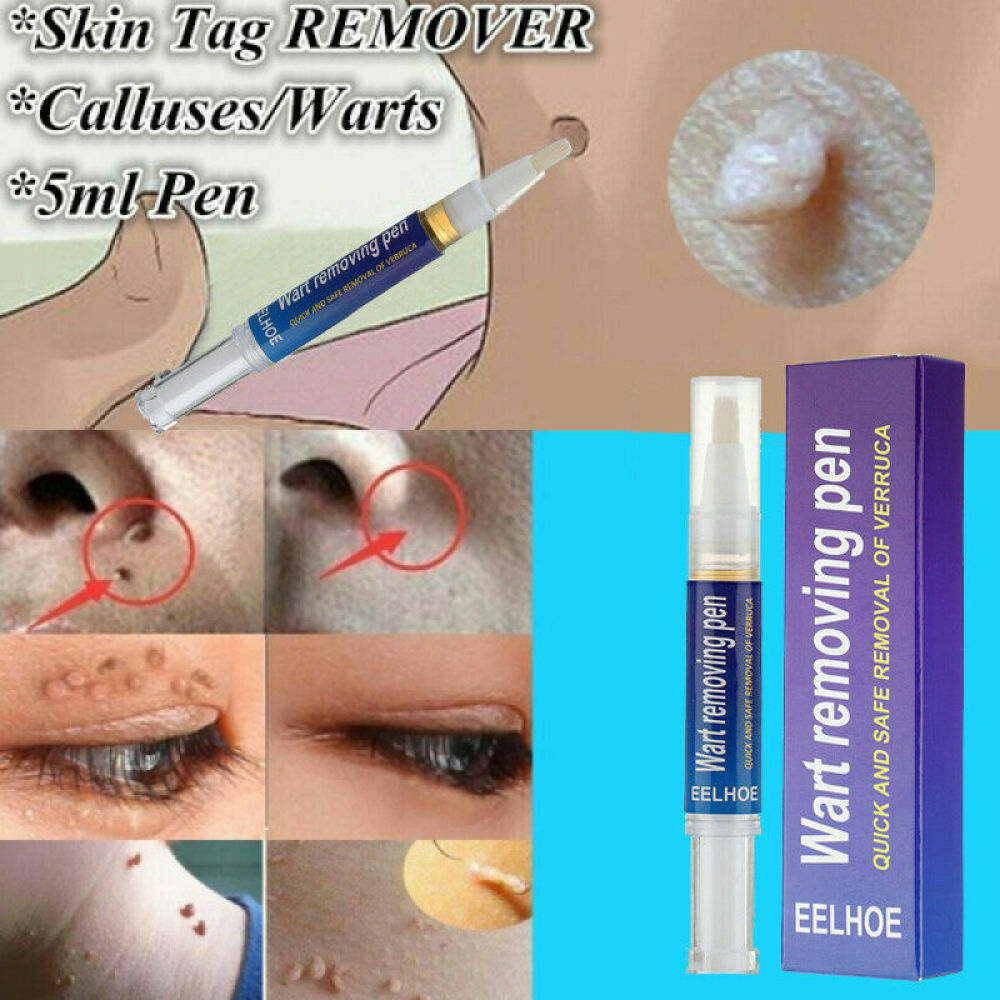 12 Hours Skin Tag Mole Wart Remover Pen Foot Corn Treatment Cream Eliminate US