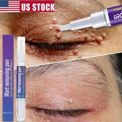 12 Hours Wart Remover Pen Skin Tag Mole Remover Eliminate Foot Corn Warts Unisex