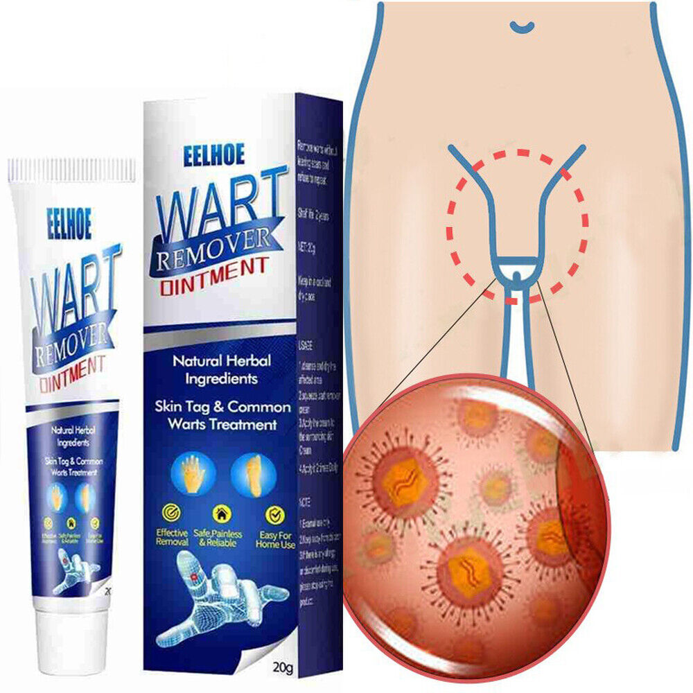Warts Remover Antibacterial Ointment Wart Treatment Cream Sk