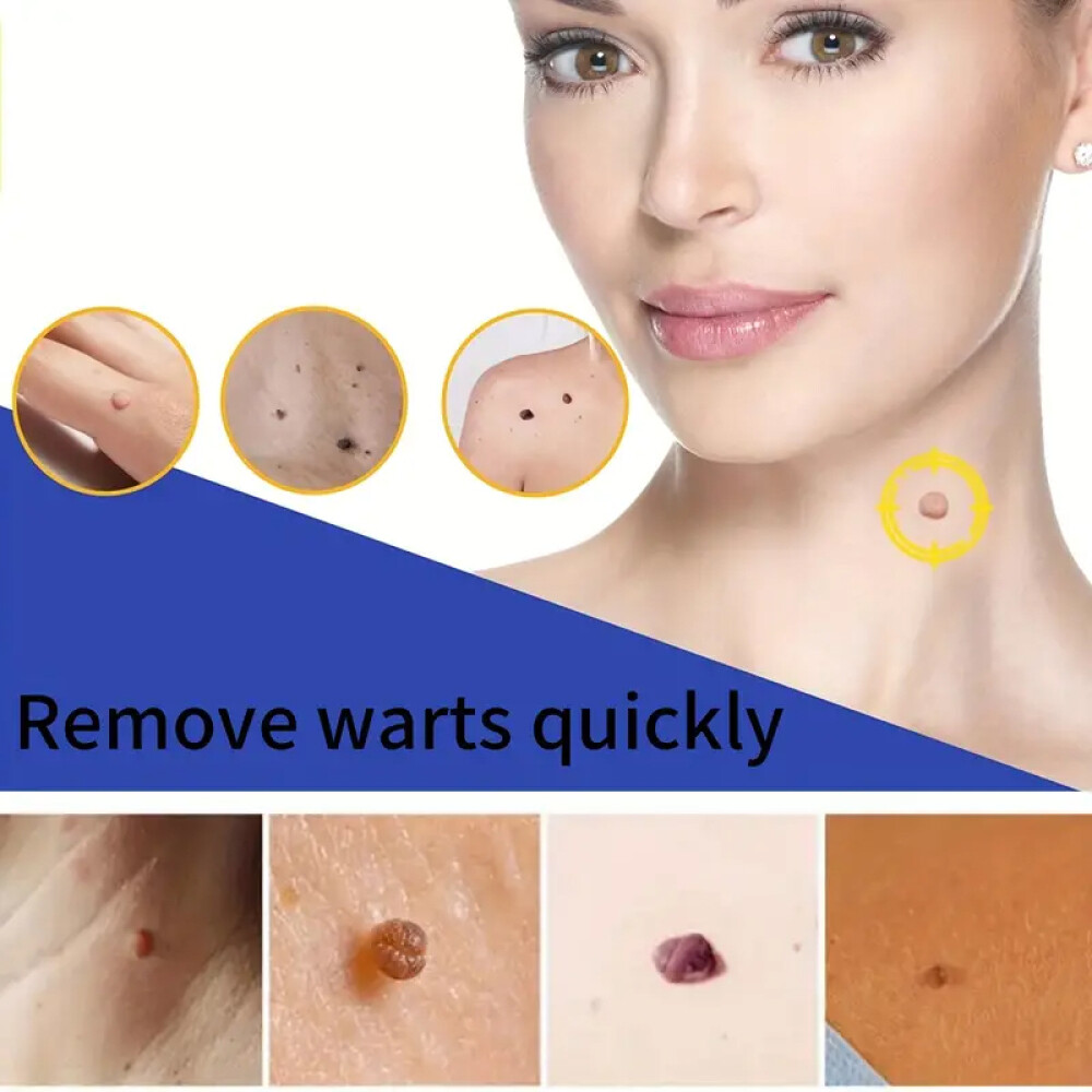 Wart Remover Liquid Skin Tag Mole Remover Eliminate Feet Corn Wart Remove Liquid