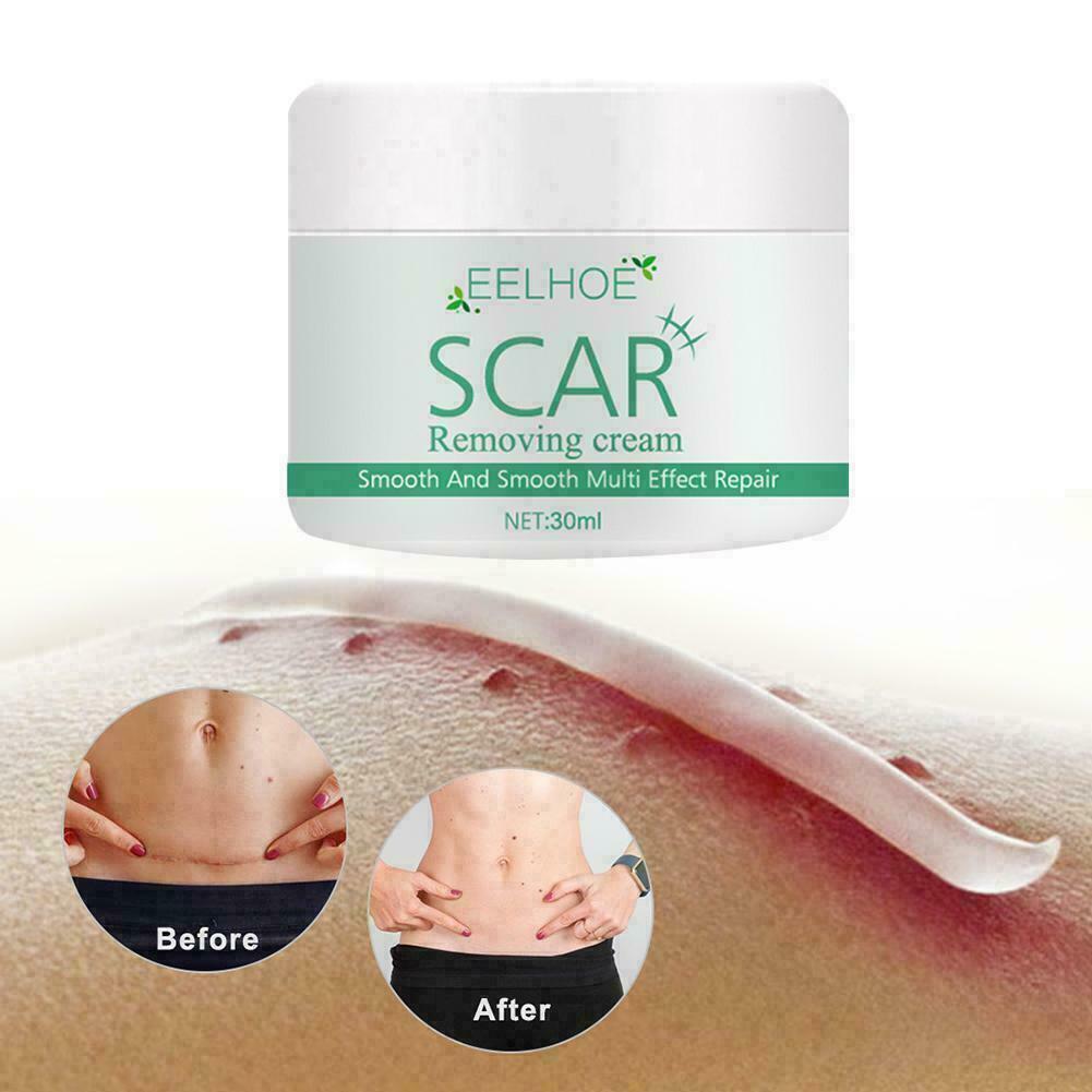 Strong Acne Scar Spots Removal Cream Cuts Burns Stretch Marks   Clarifying HOT~