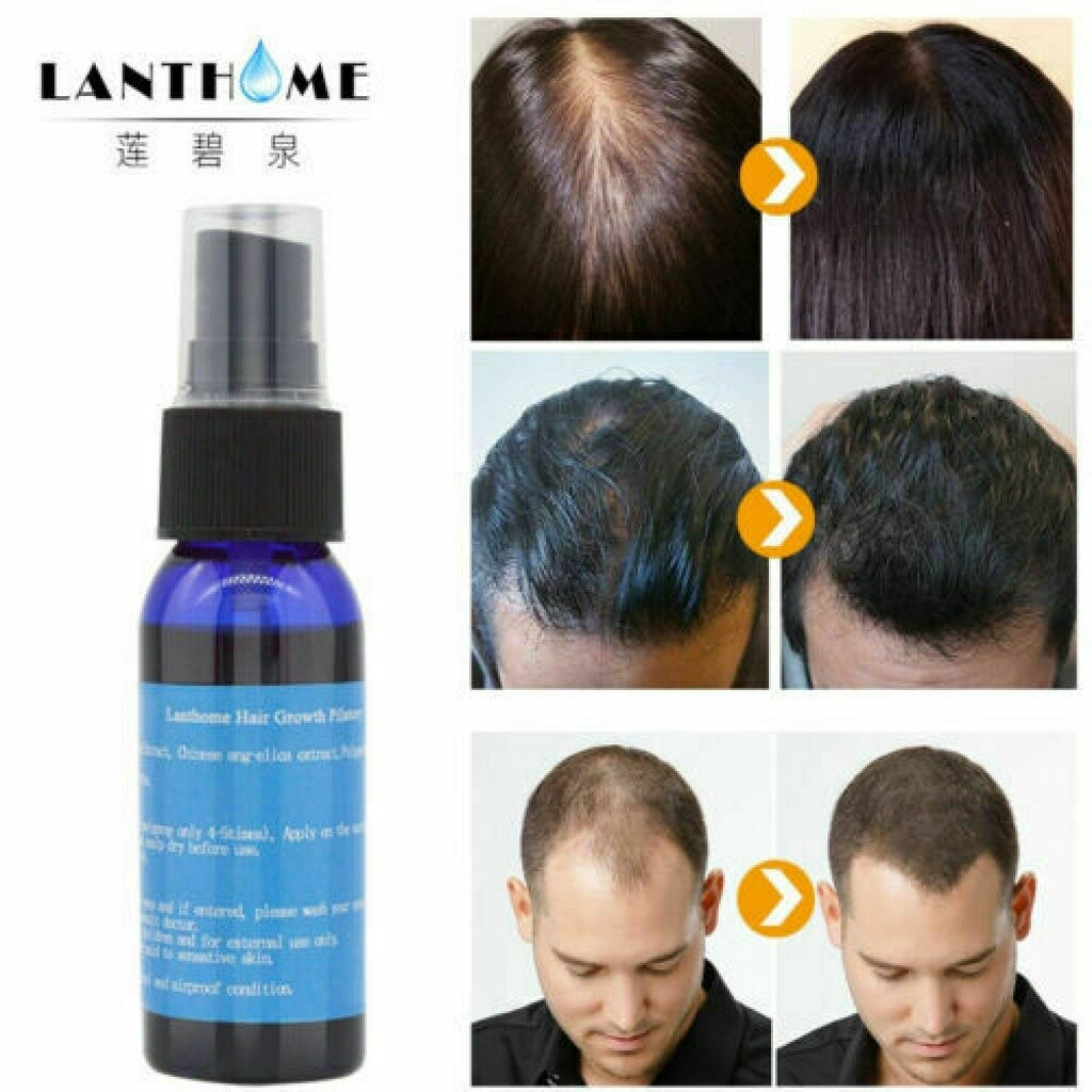 Alopecia Areata Postpartum