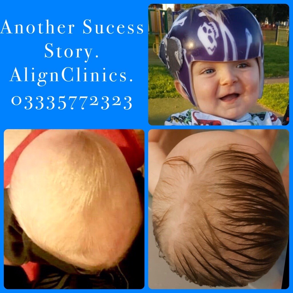 Plagiocephaly, Brachycephaly, Flat Head Syndrome Helmet