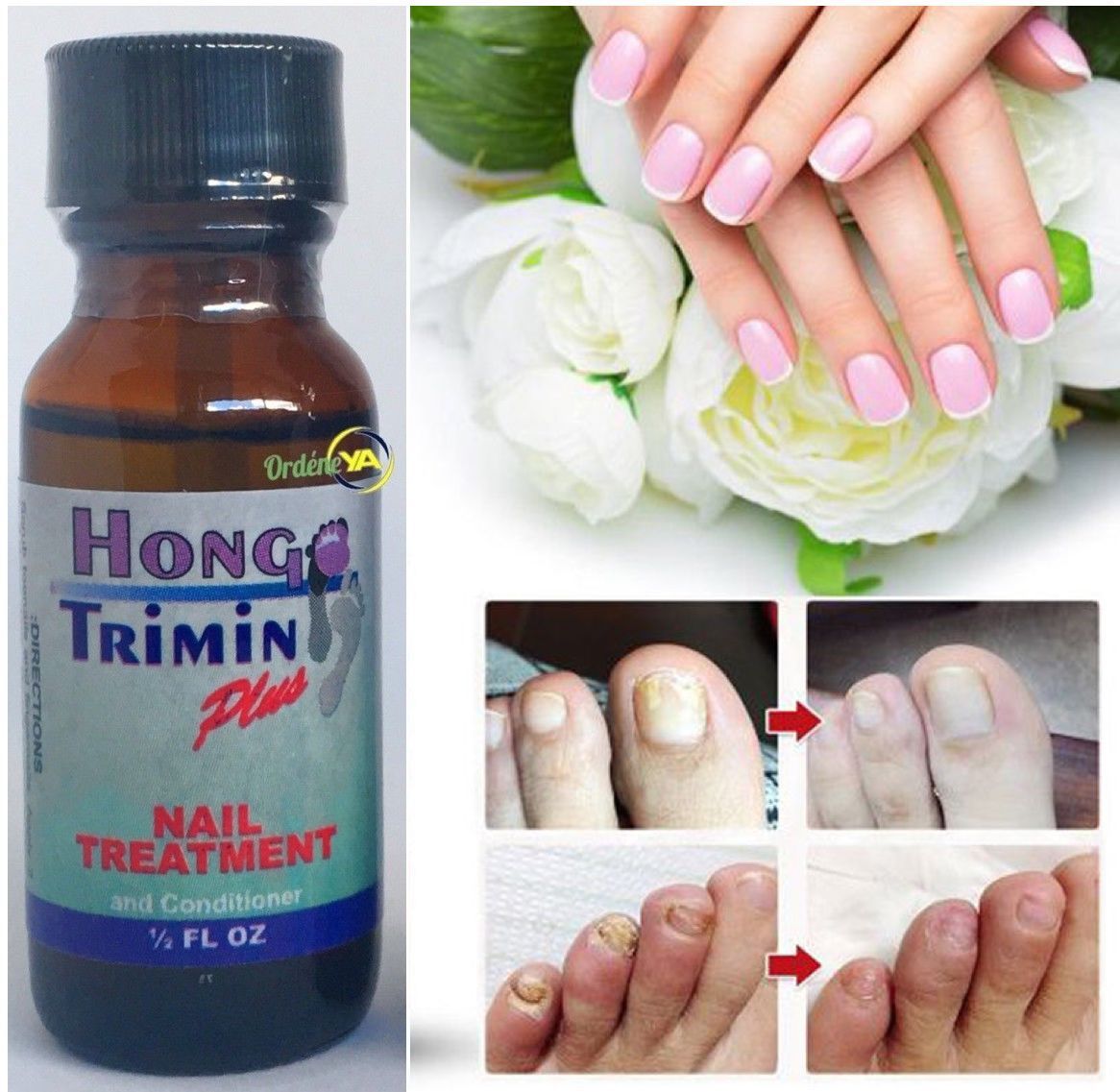 Hongo Trimin Zana Nails Fungus Nail fungus quick Treatment for fungi