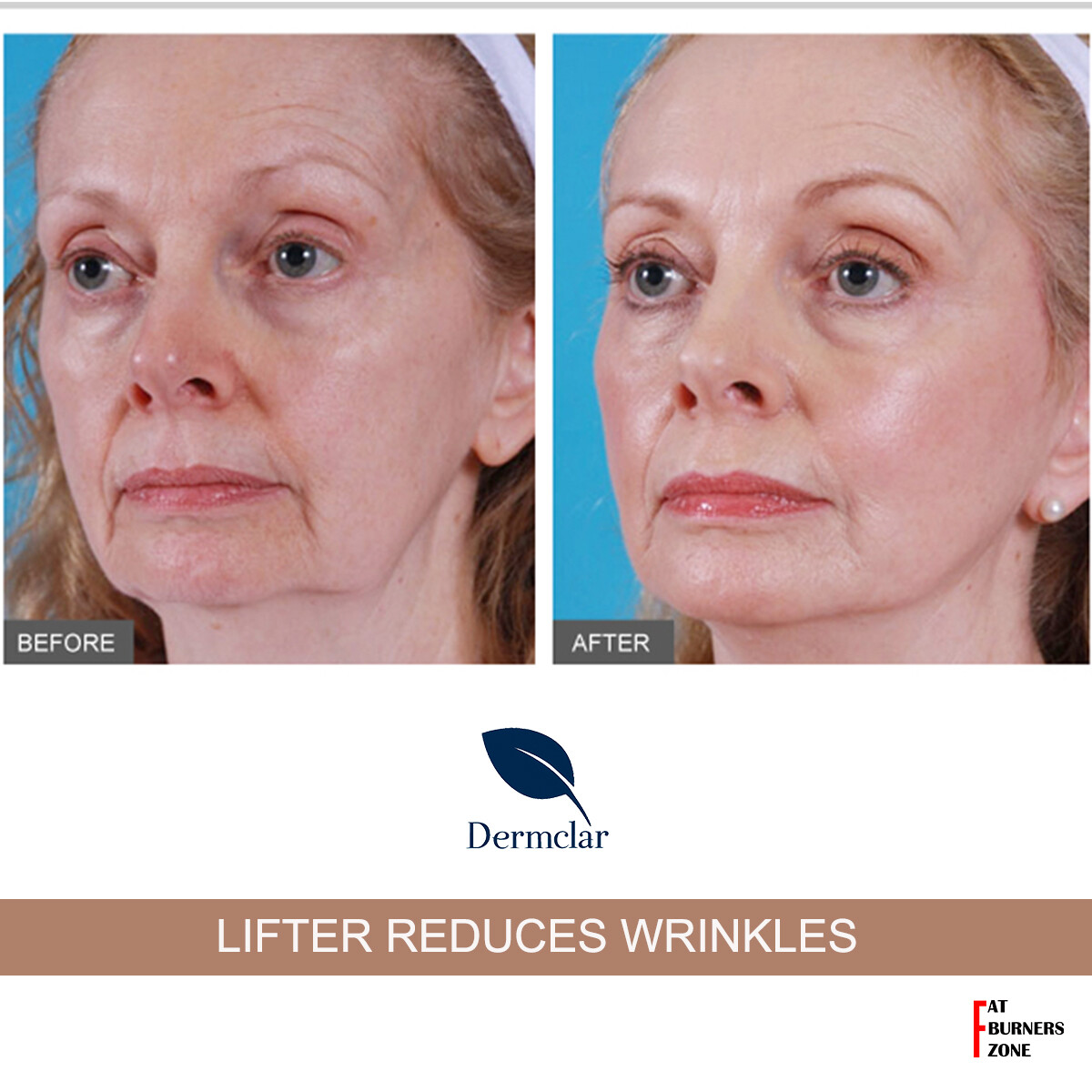 DMAE LIFT SOLUTION 3 DERMCLAR MESOTHERAPY 50ml FLACCID NECK FACE ANTI