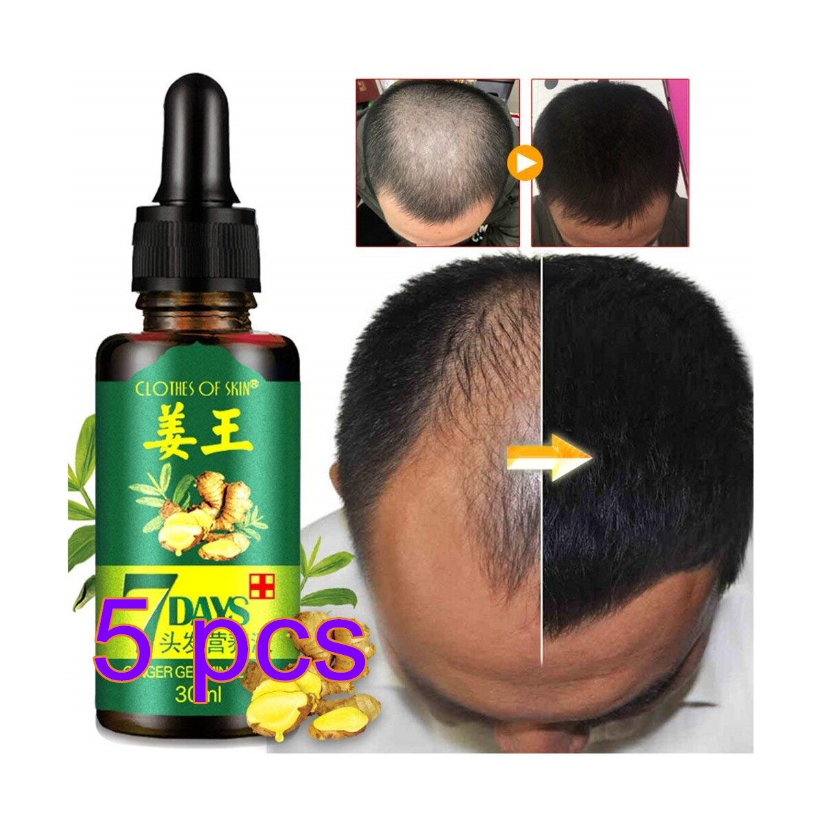 5pcs Hair Growth Essential Oil Ginger Hair Loss Baldness Treatment