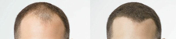 Hair Fibers For Xfusion Bottles -  Refill Bag FREE FAST SHIP USA