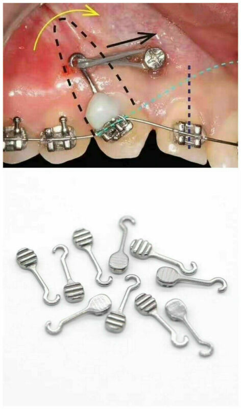 Dental Bonding Crimpable Hook Orthodontic Adhesive Hooks Arch Wire Right/left