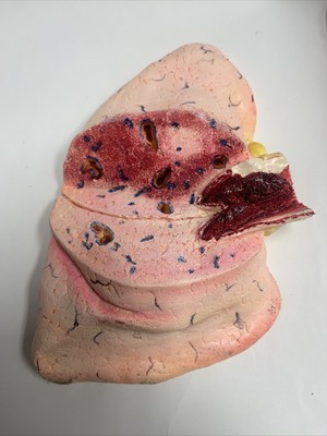 Vintage Lung Pulmonary Embolism Pathology Model Lungs Respiratory
