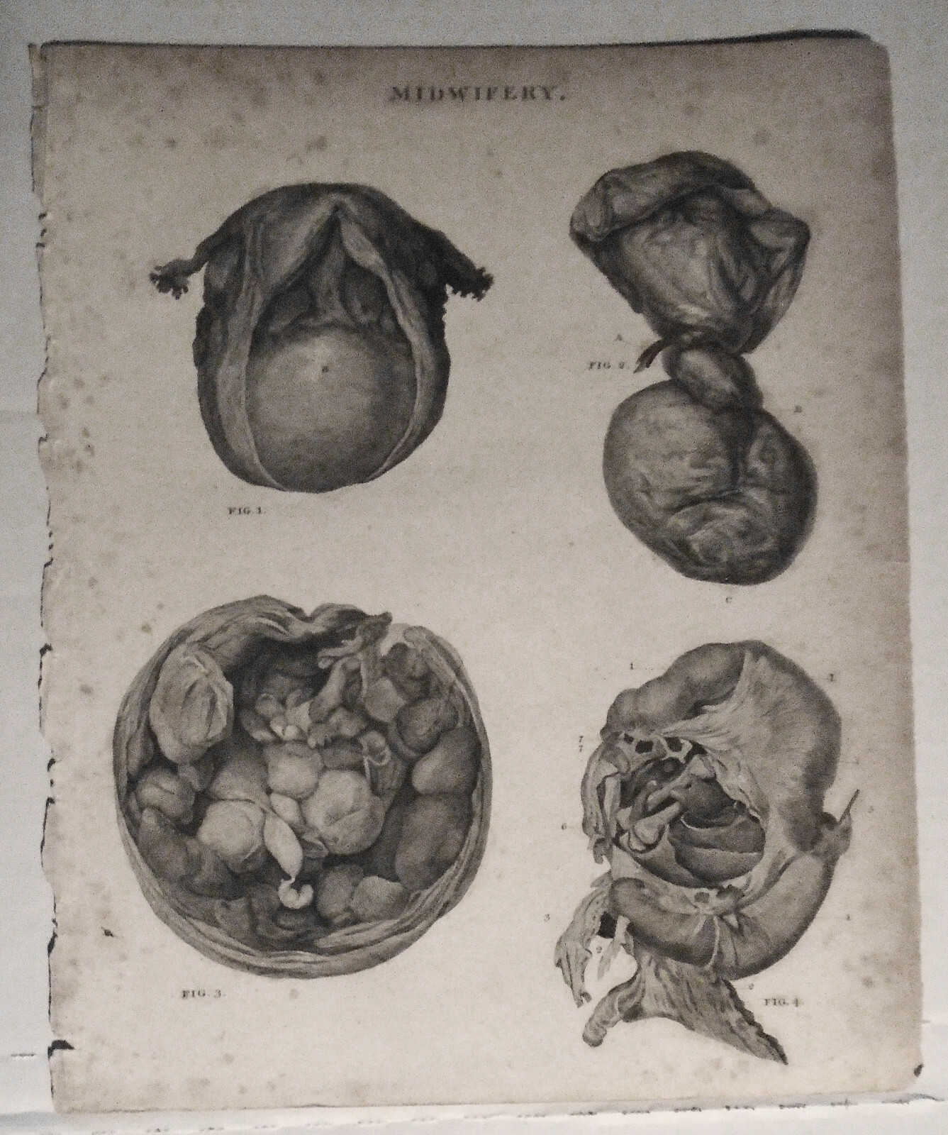 MIDWIFERY - engraved plate from Rees' Cyclopaed...