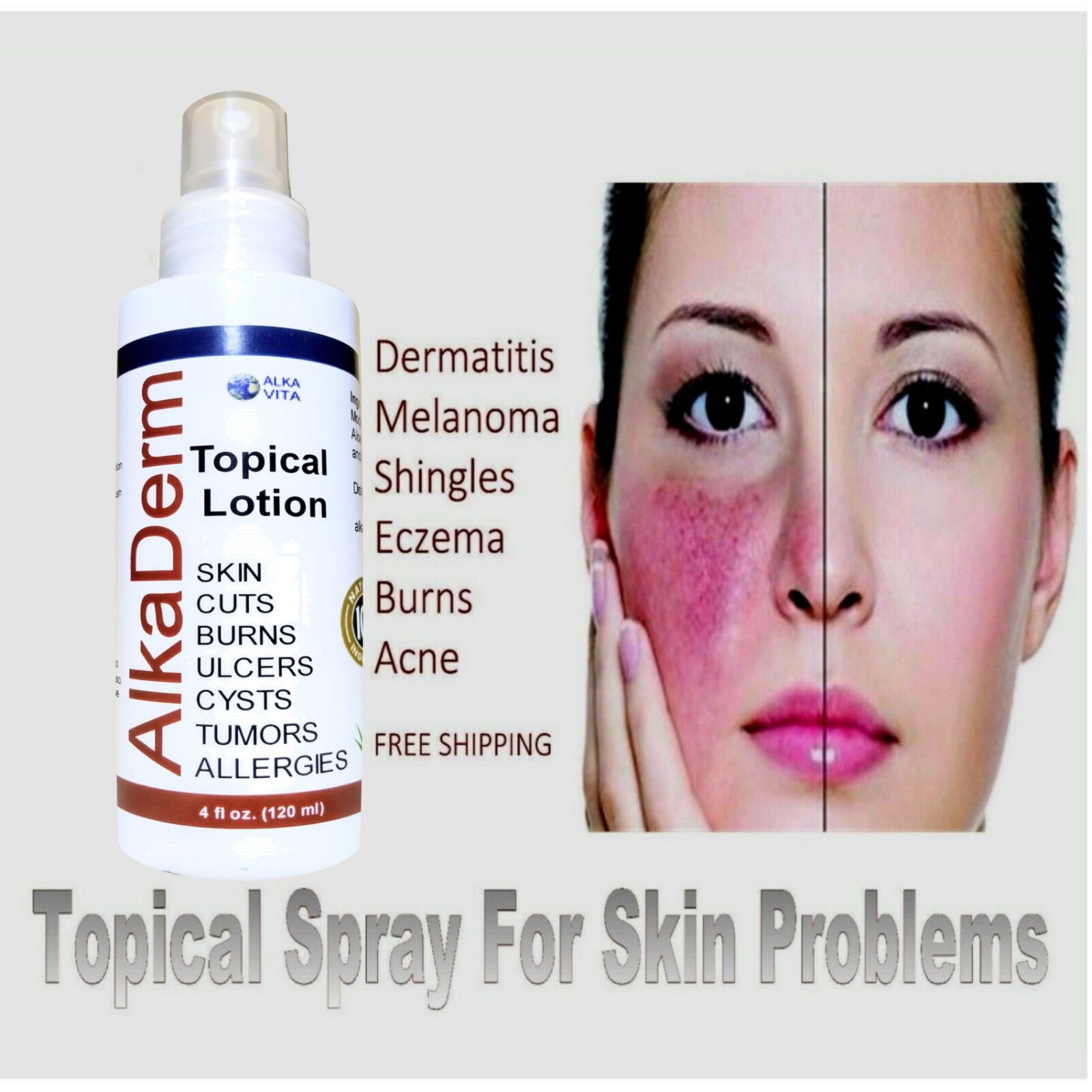 Skin Dermatitis Shingles Herpes Eczema Psoriasis ALKADERM SILICA SPRAY ALKAVITA