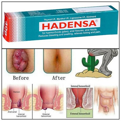 Hadensa Ointment used in the treatment of piles 20gm fissures, and anal fistula.