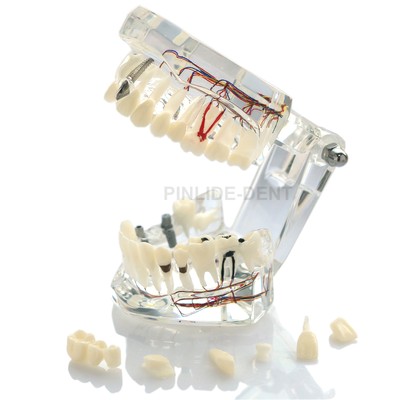 Dental Neural Repair Pathological Implant Pathological Removable Teeth Model