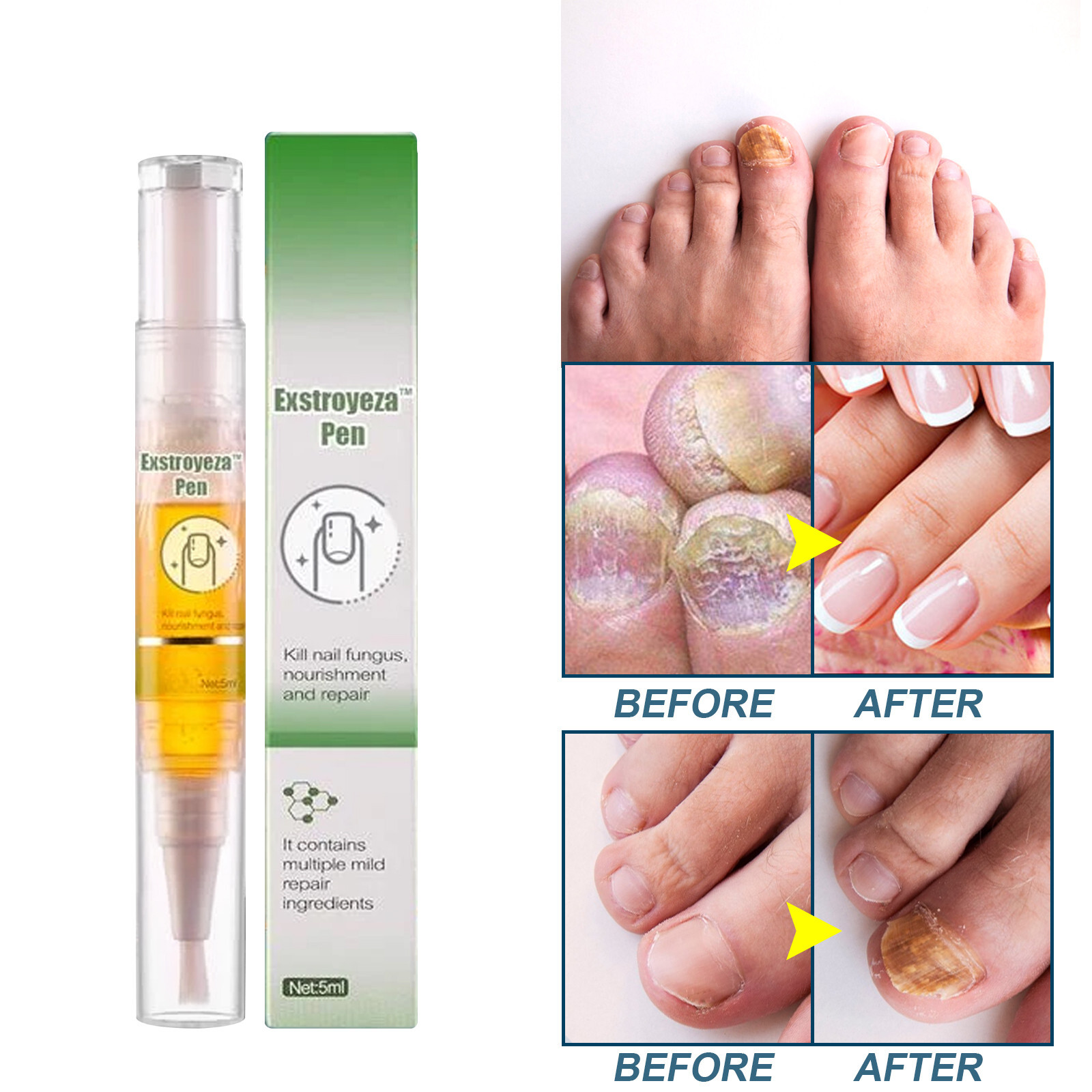 Hand File for Acrylic Nails Exstroyeza Pen FUNGAL NAIL PEN Nail Repair