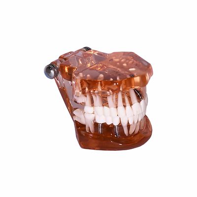 Dental Demonstration Teeth Educational Model Bridge, Implants, Tooth Decay #3002