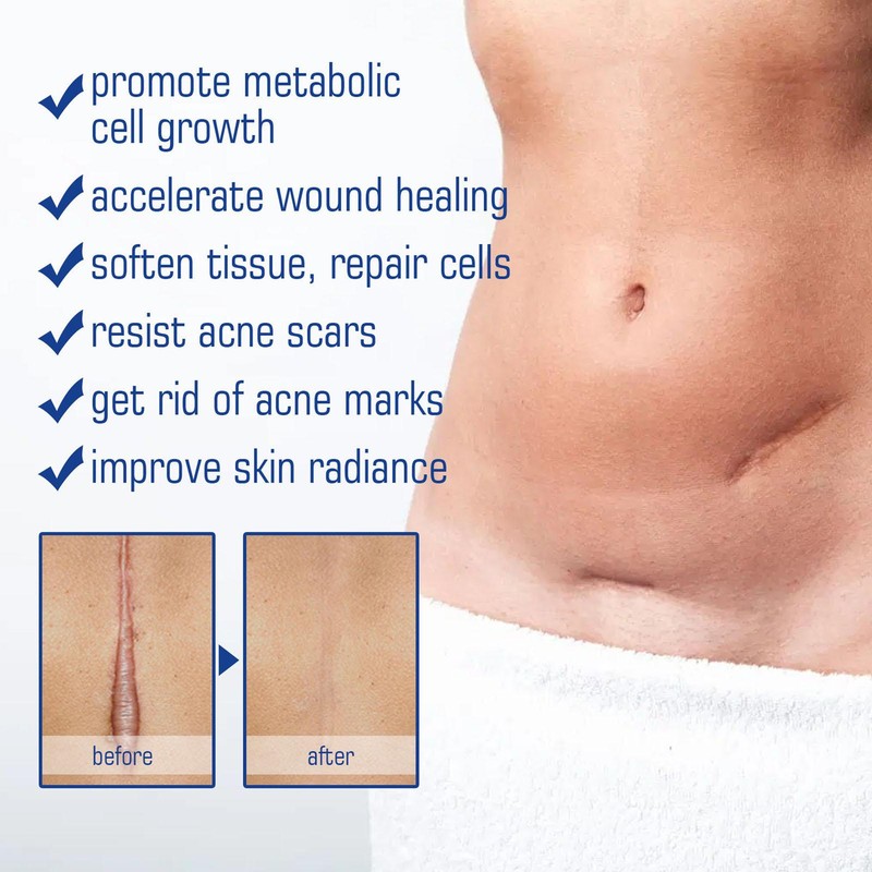 Scar Acne Removal Skin Care Stretch Marks Lighten Old Scars Burns Repair Essence