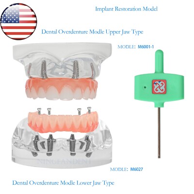 US Dental All-on-4 Overdenture Implant Model, Upper/Lower Jaw-Clear,With 4 Screw