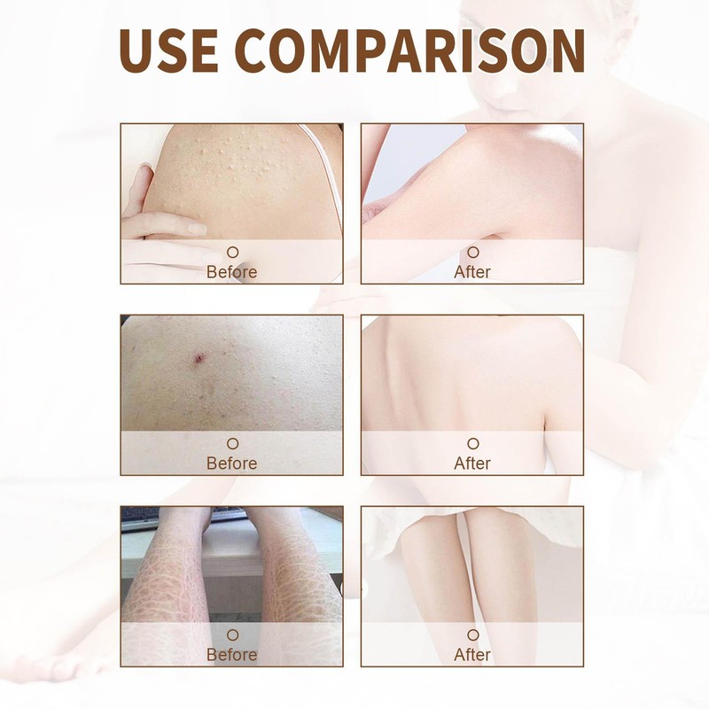 Curing Keratosis Pilaris Chicken Skin Body Lotion Skin Repair Cream Dry Skin