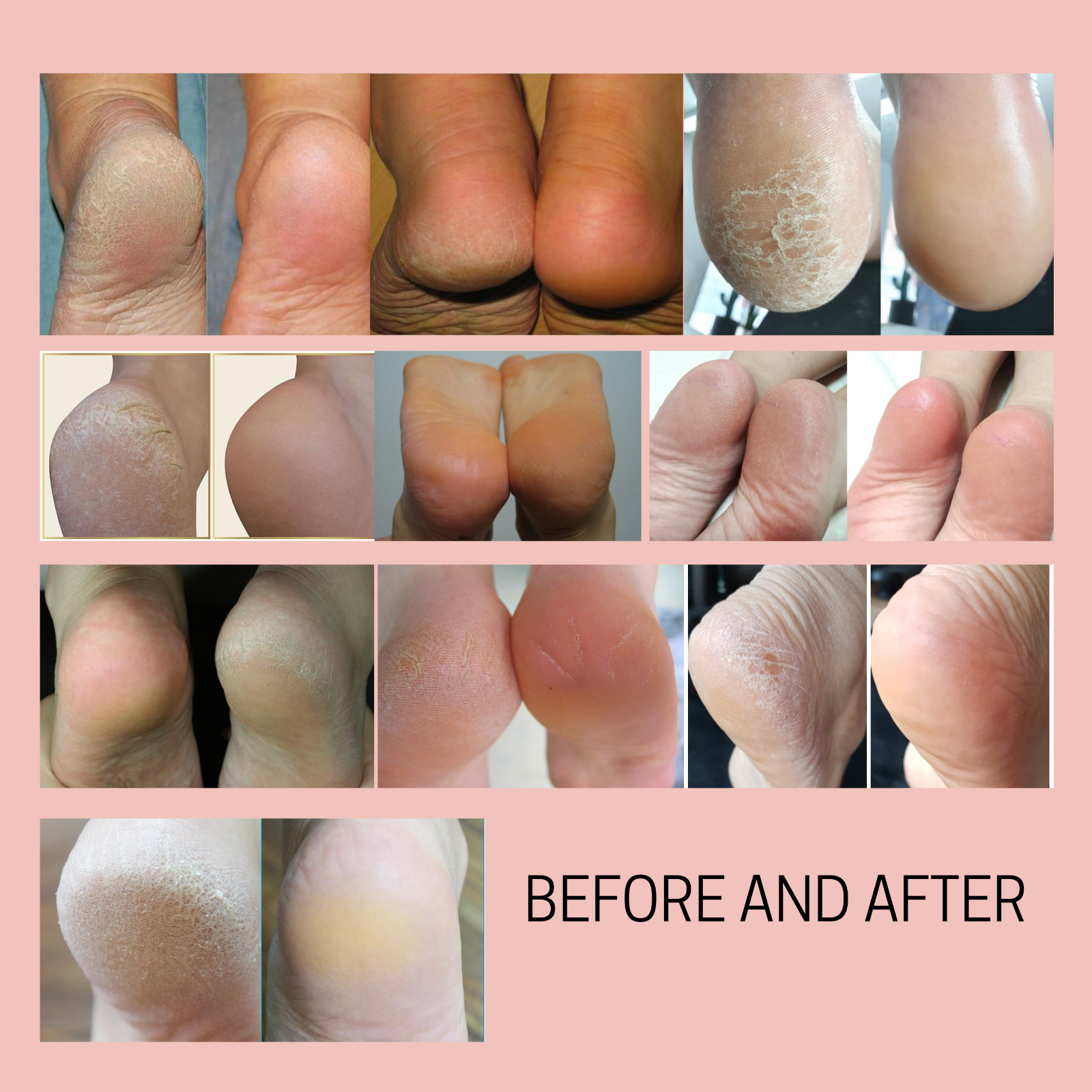 Callus Remover Quick Fix Foot File Rasp + Instant Exfoliating Softener Spray