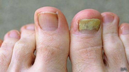 HONGO TRIMIN ORIGINAL ANTI FUNGAL 120 CAPS & 1 CREAM NAIL IMPROVED FORMULA