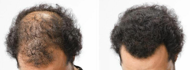 Hair Fibers For Xfusion Bottles -  Refill Bag FREE FAST SHIP USA