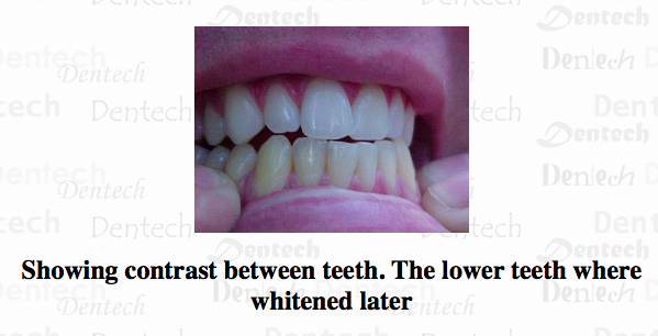 16%hp LED whitening professional 2.5 gram Pen. Teeth Whitening 100 wholesale lot