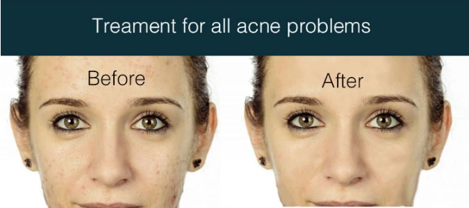 KStiMs  20ml 3day acne cream with Tea Tree oil and Salycylic acid