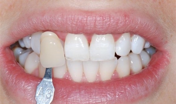 20 Moldable Teeth Trays | Thermoforming Mouth Trays Teeth Whitening Bleaching 722512343849 | eBay
