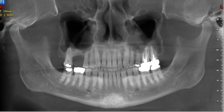 NewTom VGi 2D 3D CBCT 6x6 to 15x15 FOV w/ Warranty, Install by Cefla / NewTom